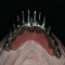 Overdenture