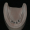 Overdenture