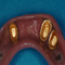 Overdenture