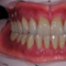 Overdenture