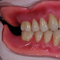 Overdenture