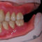 Overdenture