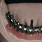 Overdenture